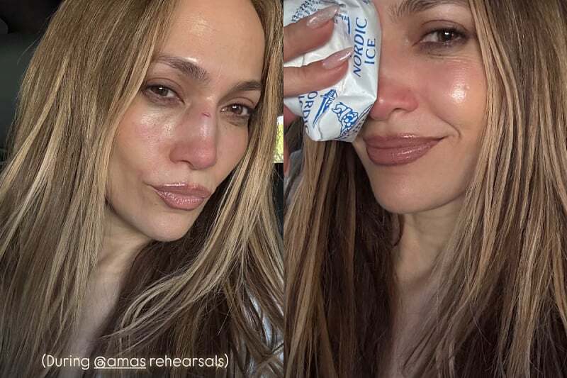 Jennifer Lopez povrijedila nos tokom probe