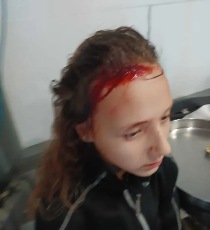 Djevojčica nakon napada