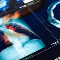 Snimak bolesnika tumor