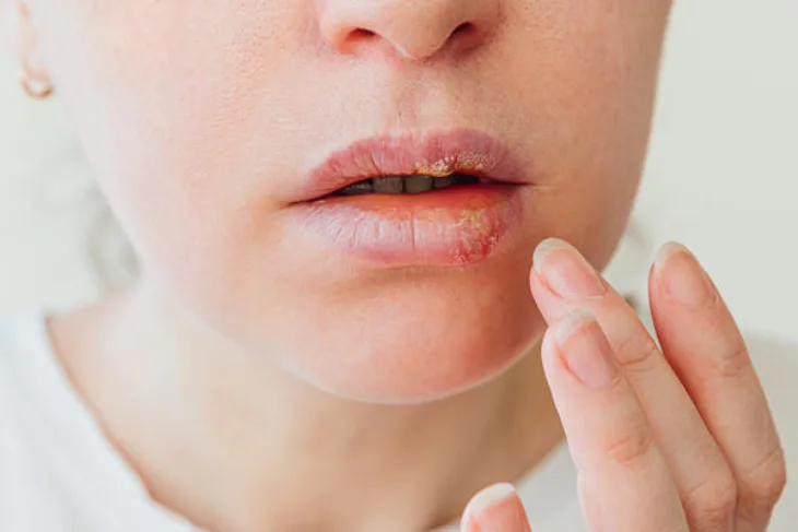 Herpes shutterstock