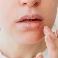 Herpes shutterstock