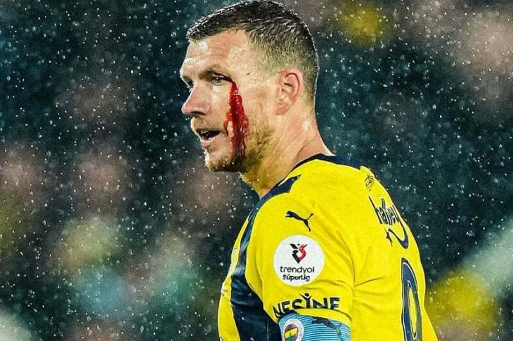 Edin Dzeko nakon udarca Foto: Twitter