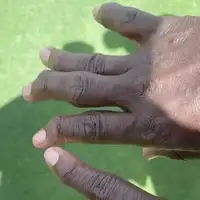 NFL Jeff Herrod Herrodovi prsti nakon dugogodisnje karijere