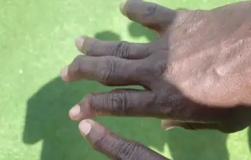 NFL Jeff Herrod Herrodovi prsti nakon dugogodisnje karijere