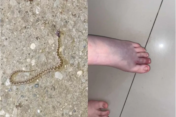 Zmija ujed