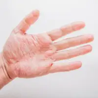 Dishidroza