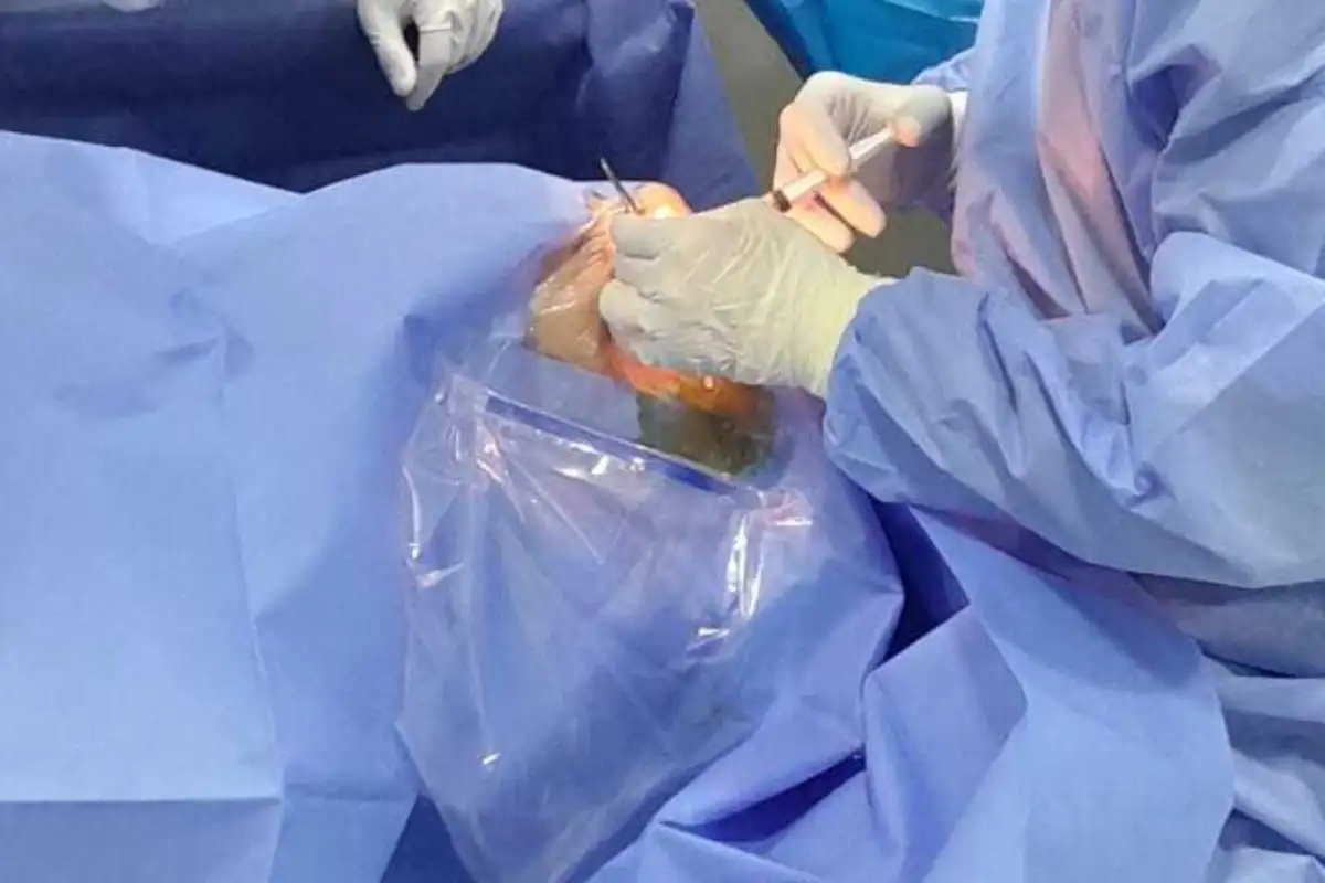 Jasmin Cerić Klinika International PLUS- zahvat na Jasminovom oku trajao je 20 minuta